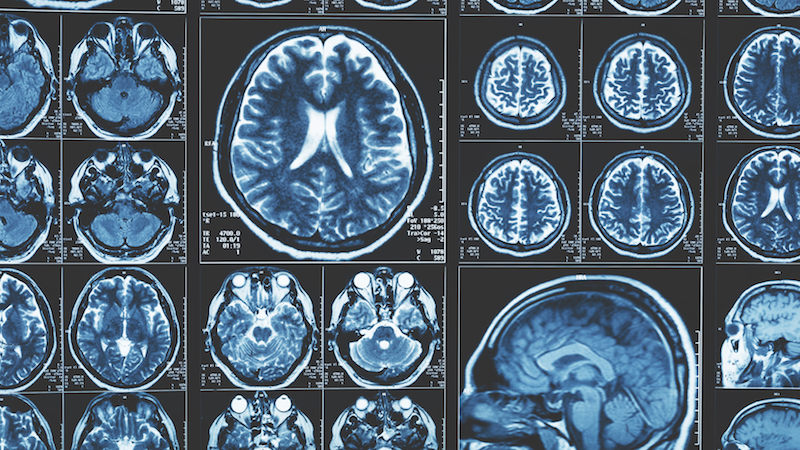 mri imaging of brain