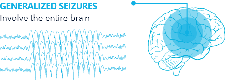 Generalized seizures