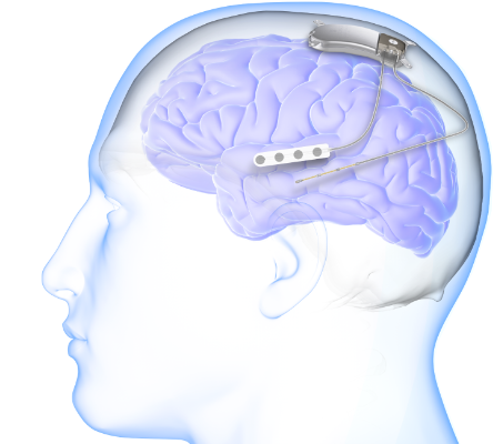 graphic of brain with RNS system