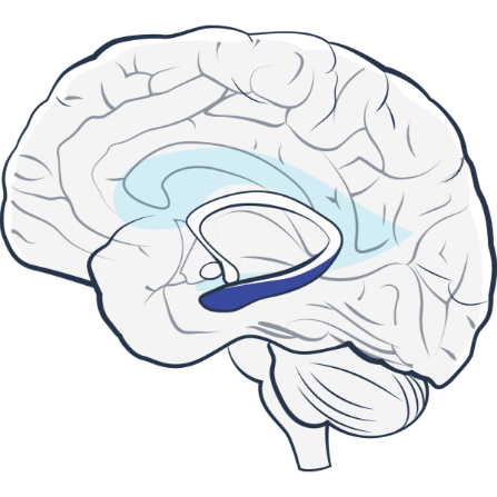 Treat mesial temporal onset seizures with RNS System